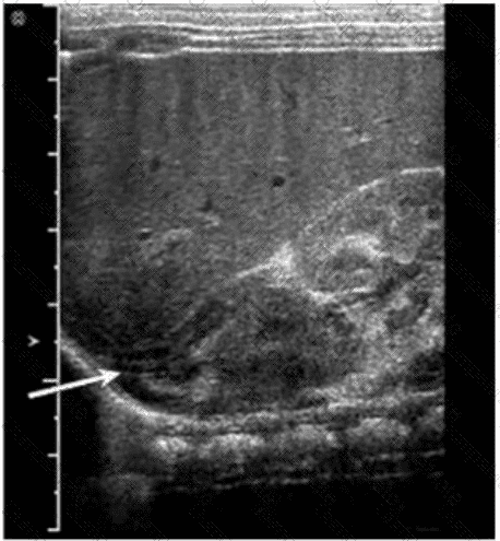 AB-Abdomen Question 32
