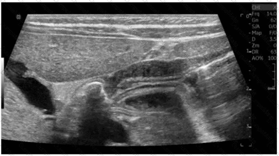 AB-Abdomen Question 41