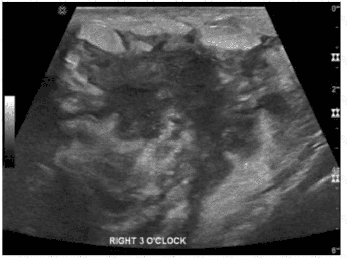 AB-Abdomen Question 38