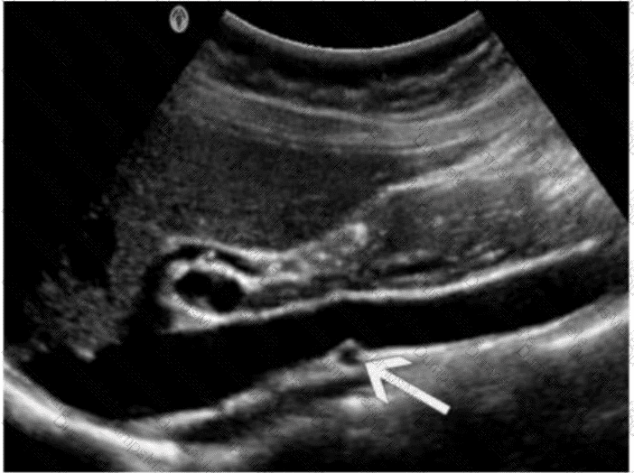 AB-Abdomen Question 17