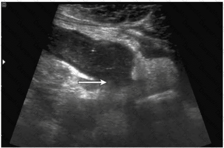 AB-Abdomen Question 39