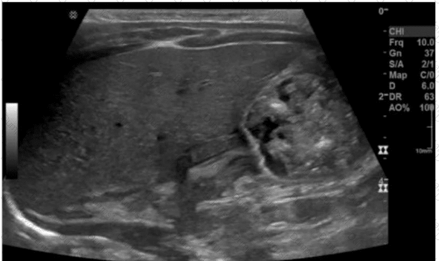 AB-Abdomen Question 38