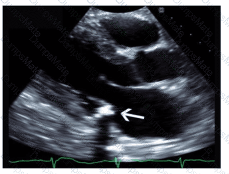 AE-Adult-Echocardiography Question 10