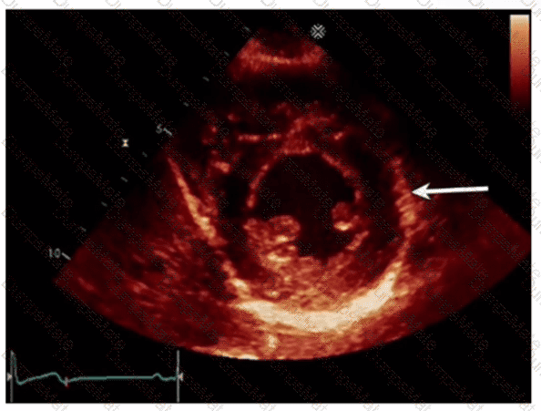 AE-Adult-Echocardiography Question 32