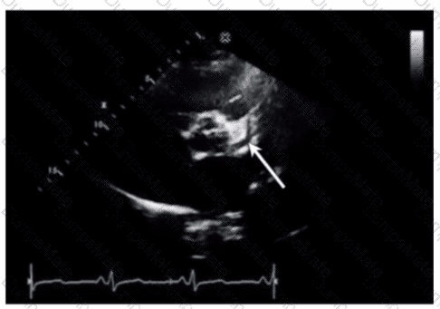 AE-Adult-Echocardiography Question 25