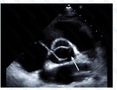 AE-Adult-Echocardiography Question 37