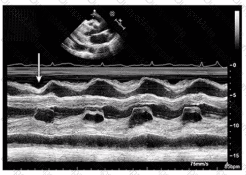 AE-Adult-Echocardiography Question 34