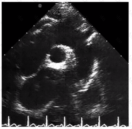AE-Adult-Echocardiography Question 21